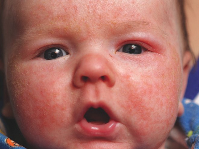 Аллергическая реакция малыша