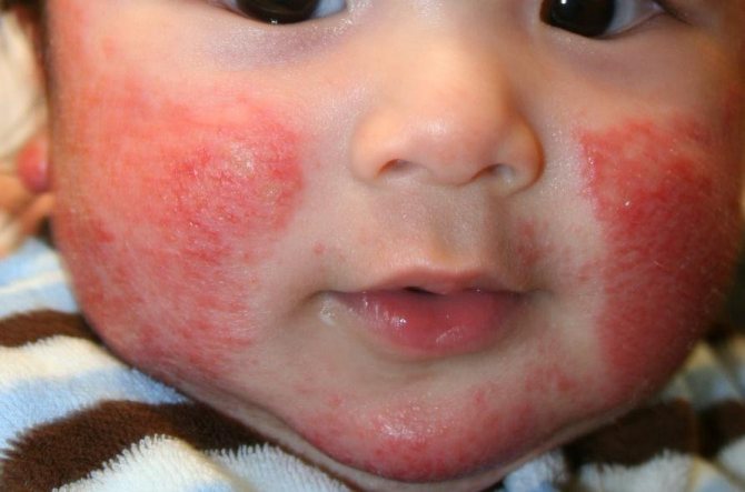 Аллергия на щеках у малыша