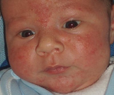 Диатез, аллергическая сыпь у малыша на лице, развивается под воздействием белков, входящих в состав молочных смесей