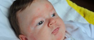 Как лечить аллергию у новорожденных на теле