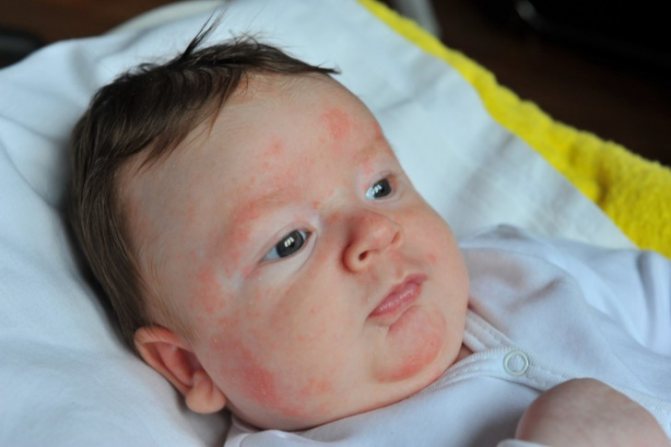 Как лечить аллергию у новорожденных на теле