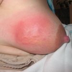 redness of the breast due to mastitis and lactostasis