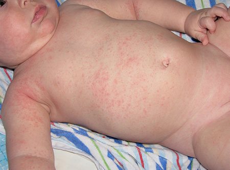 Потница – один из наиболее частых видов высыпаний на теле новорожденных деток